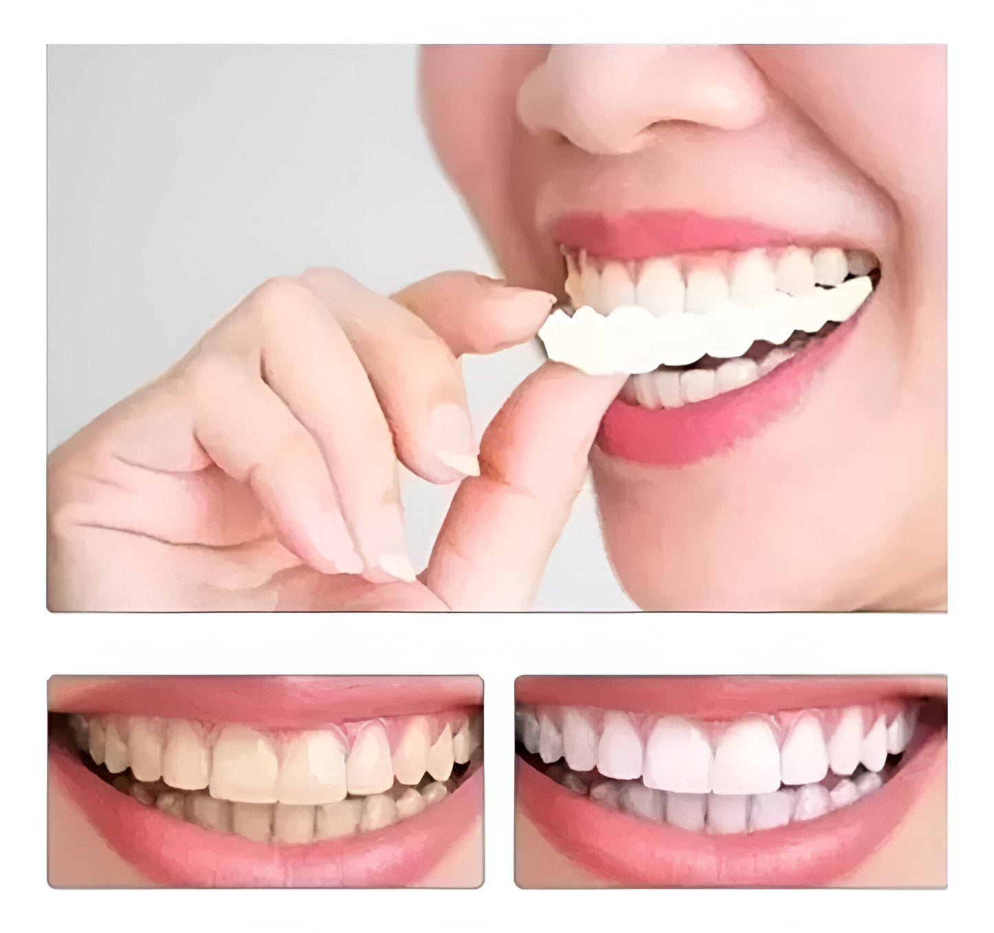 Carillas Dentales - Solución rapida para una sonrisa perfecta